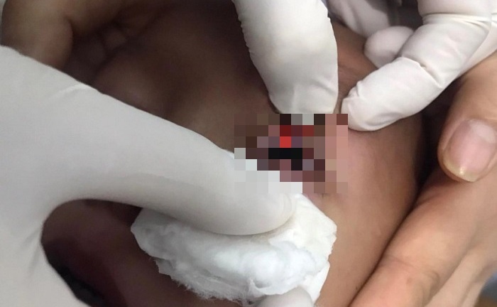 Tin tức đời sống ngày 31/5: Gắp thành công con vắt đang di chuyển trong mắt bé 4 tuổi