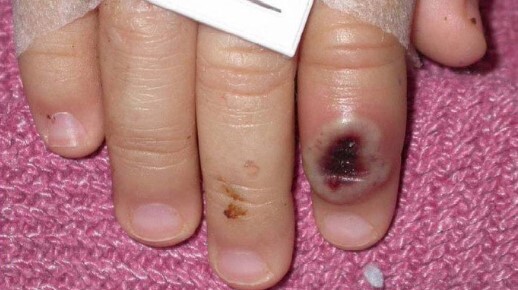 Phát hiện trẻ mắc đậu mùa khỉ đầu tiên trên thế giới 