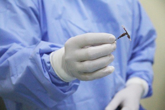 Tin tức đời sống ngày 29/6: Vòng tránh thai hóa sỏi nằm trong bàng quang người phụ nữ