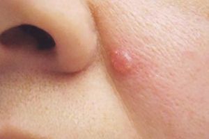 Tự điều trị nốt sần dưới cánh mũi 4 năm không khỏi, đi khám mới biết bị ung thư da