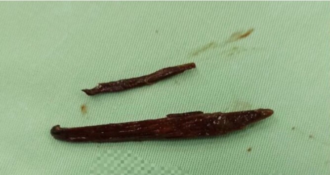 Tin tức đời sống ngày 14/7: Cấp cứu bệnh nhân bị hai mảnh gỗ đâm thủng ruột non