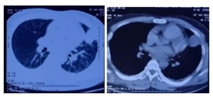 Khó thở và sốt cao liên tục, người đàn ông phát hiện bị viêm phổi do vi khuẩn Whitmore