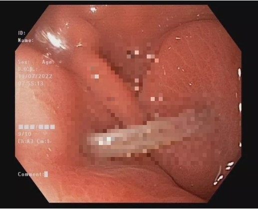 Tin tức đời sống ngày 19/7: Gắp xương cá dài 4cm đâm vào dạ dày bệnh nhân 40 tuổi