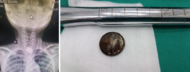 Tin tức đời sống ngày 4/8: Bé gái 8 tuổi nhập viện vì vô tình nuốt viên pin cúc áo