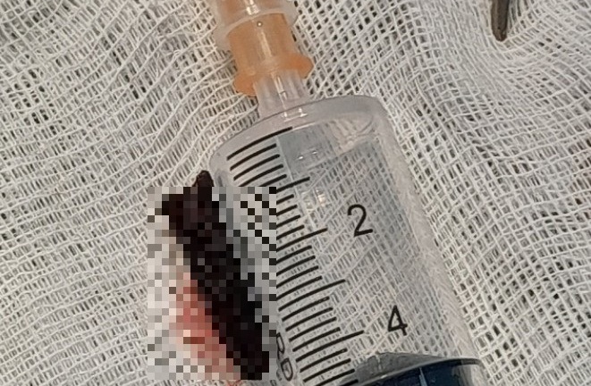 Tin tức đời sống ngày 13/8: Mảnh gỗ nằm trong cổ người đàn ông suốt 4 tháng