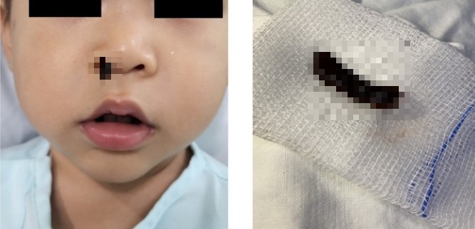 Tin tức đời sống ngày 17/8: Con vắt sống gần 20 ngày trong mũi bé 18 tháng tuổi