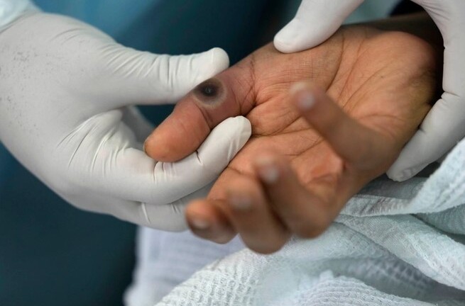 Trung Quốc ghi nhận ca bệnh đậu mùa khỉ đầu tiên