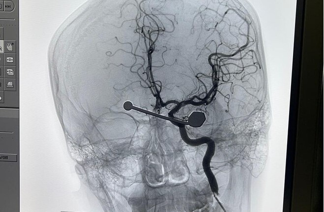 Tin tức đời sống ngày 22/9: Thanh sắt cắm sâu vào mắt trái của nam thanh niên 