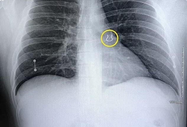 Người đàn ông nhập viện vì ho dữ dội, ảnh chụp X-quang tiết lộ điều khó tin