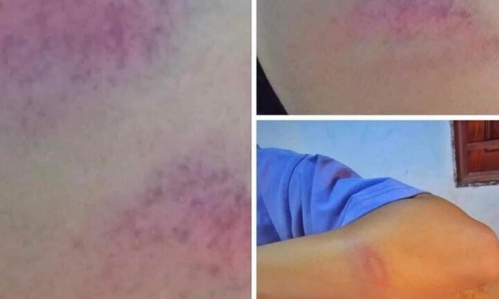 Thầy giáo ở Nghệ An bị tố đánh bầm tím tay nữ sinh lớp 7