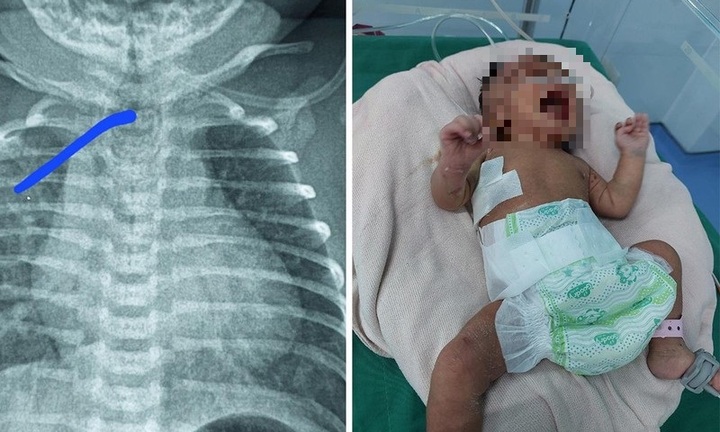 Tin tức đời sống ngày 4/10: Bé gái bị tẹo thực quản bẩm sinh hiếm gặp