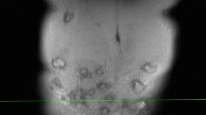 Tin tức đời sống ngày 5/10: Bụng xuất hiện hàng loạt ổ áp xe sau khi tiêm tan mỡ ở spa