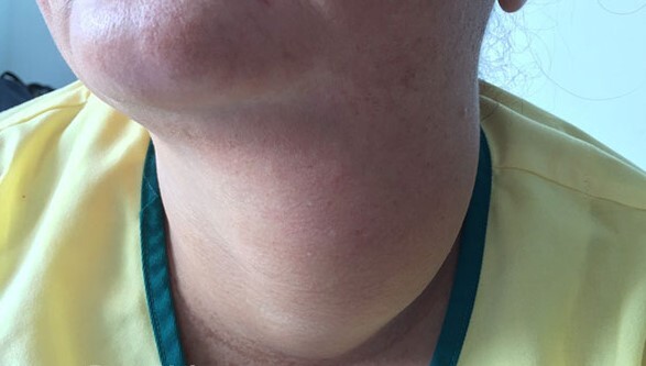 Tin tức đời sống ngày 18/10: Phẫu thuật bóc tách bướu cổ nặng gần 1kg cho nữ bệnh nhân