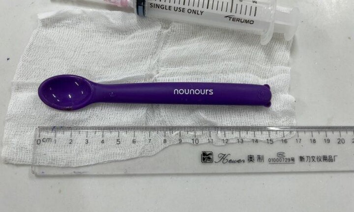 Tin tức đời sống ngày 27/10: Thìa nhựa dài 15cm nằm trong dạ dày cô gái 20 tuổi