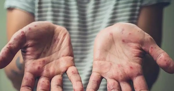 Bộ Y tế xếp đậu mùa khỉ vào danh mục bệnh truyền nhiễm nhóm B