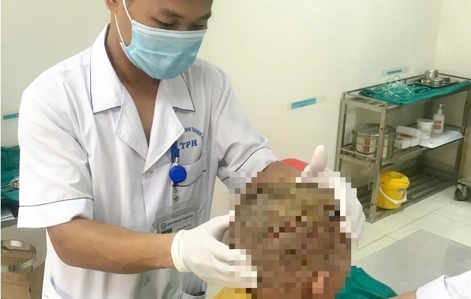 Bé trai ở Thanh Hóa bị chó cắn tổn thương nặng tại vùng đầu, mặt