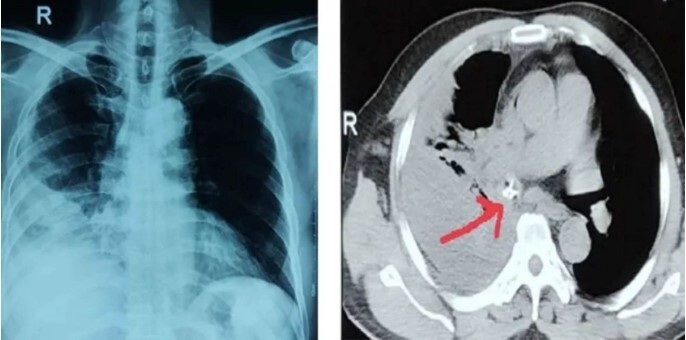Tin tức đời sống ngày 18/12: Người đàn ông đau ngực, khó thở kéo dài chỉ vì mảnh mỏ gà