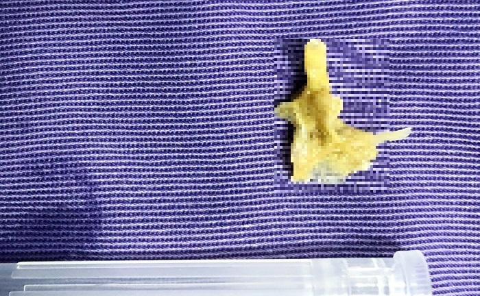 Tin tức đời sống ngày 31/12: Nội soi gắp mảnh xương cá trong thùy phổi cụ bà 75 tuổi