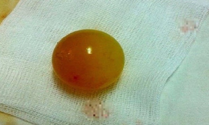 Tin tức đời sống ngày 23/2: Nuốt món đồ quen thuộc, bé gái phải mổ khẩn vì tắc ruột