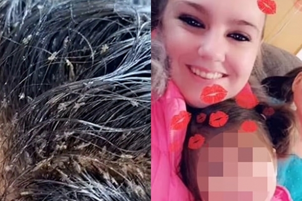 Bé gái suýt mất mạng vì đống chấy rận