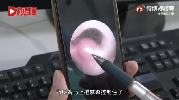 Bé trai 8 tuổi suýt mất mạng vì nhiễm trùng não, bác sĩ cảnh báo dừng ngay thói quen nhiều người mắc phải