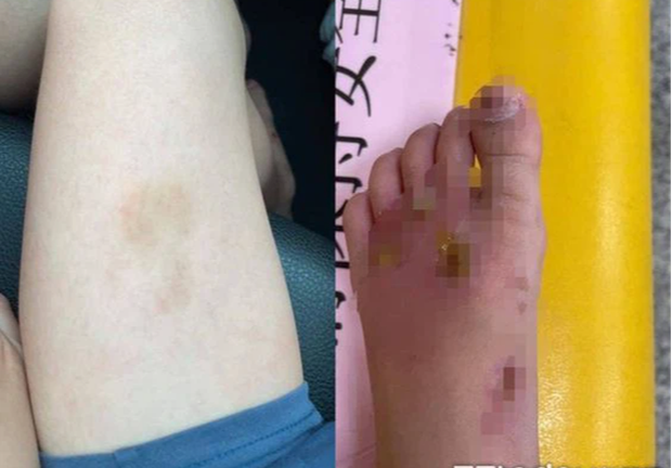 Thuê bảo mẫu chăm sóc con trai, người mẹ sốc nặng khi phát hiện cơ thể tàn tạ của đứa trẻ