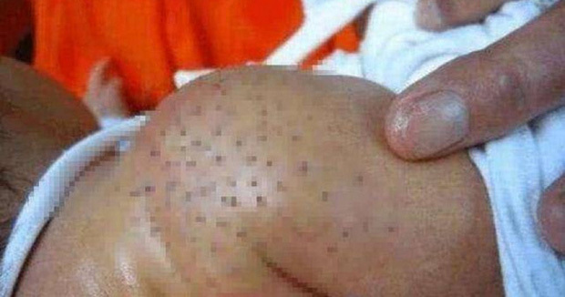 Gửi con trai ở nhà bà nội, người mẹ tá hỏa khi phát hiện cơ thể đứa trẻ chi chít vết chấm đen