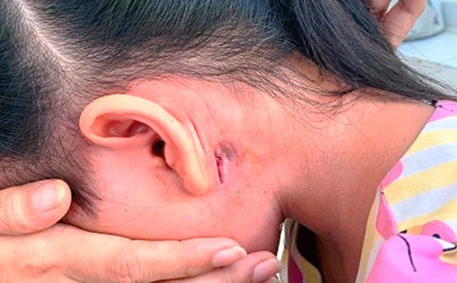 Nữ sinh ở Đắk Lắk được phát hiện mắc bệnh 