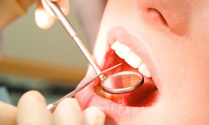 Lấy cao răng có cần thiết không và khi nào nên lấy?