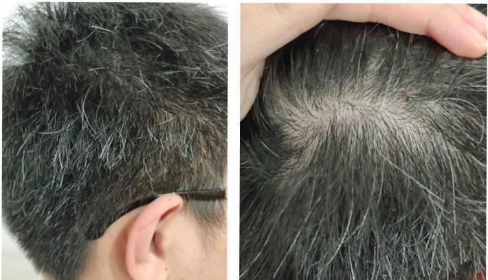 Nhiều người trẻ tóc bạc trắng từ sớm, bác sĩ chỉ ra nguyên nhân