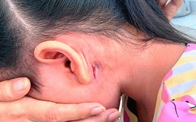 Bệnh Whitmore có lây không?