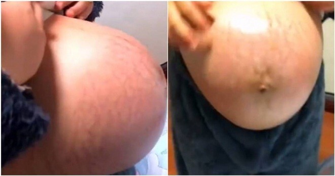 Vợ bầu bị rạn da vừa ngứa rát vừa đau đớn, chồng thốt lên 2 câu khiến dân mạng ức chế