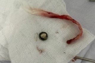 Bé gái nhập viện vì nhét viên pin vào mũi