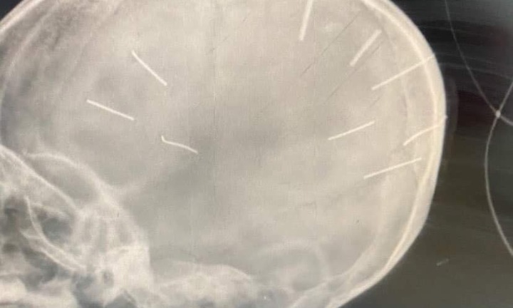 Công an vào cuộc điều tra vụ bé gái 3 tuổi nghi bị 9 đinh bắn vào sọ, nguy kịch