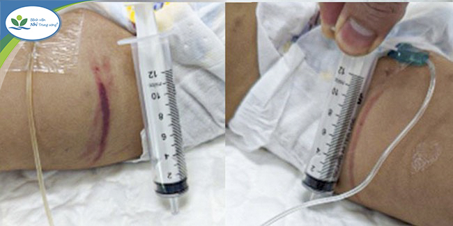 Vụ bé 1 tuổi bị bạo hành ở Hà Nội: Sốt 5 ngày nhưng không được đưa vào viện