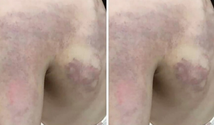 Xác minh nghi vấn giáo viên đánh học sinh lớp 3 bầm tím vì...không thuộc bài