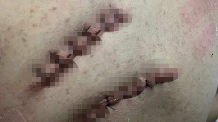 Người đàn ông 32 tuổi bị nhóm côn đồ chém sau tiệc sinh nhật