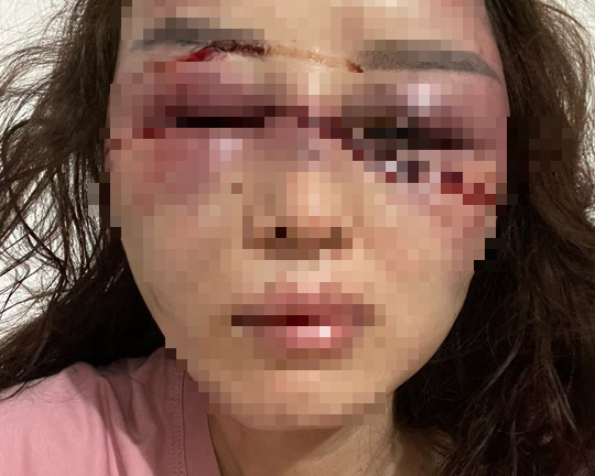 Vụ cán bộ QLTT bị tố đánh đập, lột đồ người tình: Nạn nhân vừa trải qua 3 tiếng phẫu thuật