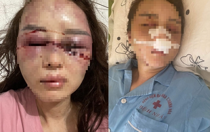 Vụ cán bộ QLTT đánh đập, lột đồ người tình: Kinh hoàng lời kể của nạn nhân