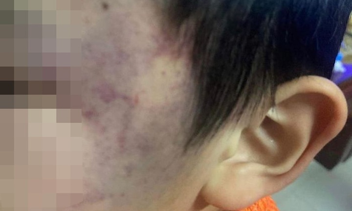 Vụ bé trai 4 tuổi bị bầm tím mặt: Công an tiết lộ bất ngờ