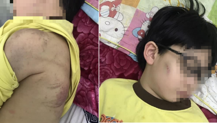 Nghi vấn cháu bé 8 tuổi ở Quảng Ninh bị mẹ đánh nhập viện do....chưa làm bài tập