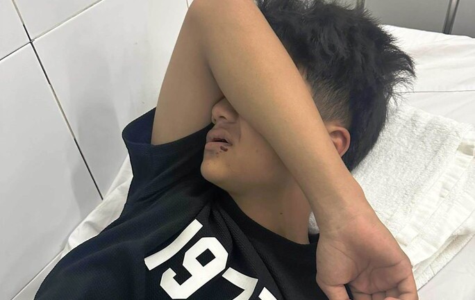 Điều tra vụ đi tắm biển, thiếu niên 14 tuổi ở Đà Nẵng bị người lạ đánh gãy 4 răng