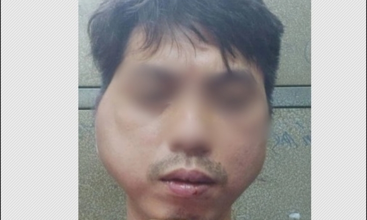 Vụ thanh niên 29 tuổi tố bị chủ quán lẩu nướng đánh biến dạng mặt: Thông tin mới nhất