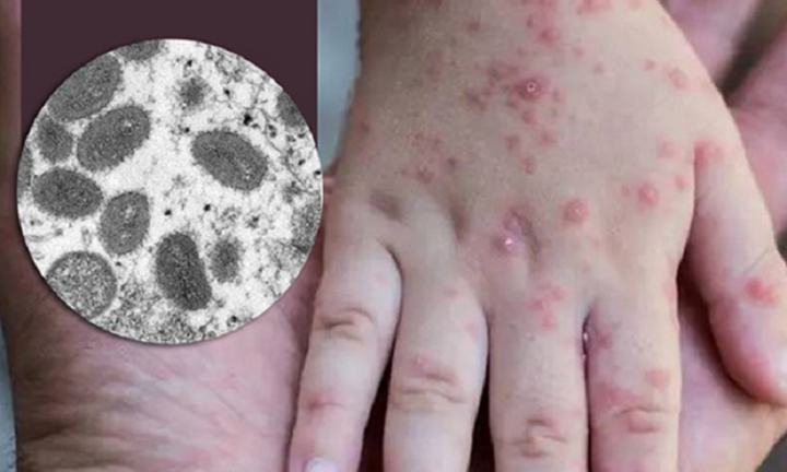 Bộ Y tế khuyến cáo 6 biện pháp phòng chống bệnh đầu mùa khỉ