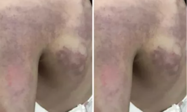 Đánh học sinh lớp 3 bầm tím người vì không làm được bài, cô giáo bị tạm đình chỉ