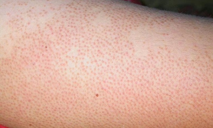 Điều trị “dày sừng nang lông” bệnh da liễu hay gặp vào mùa đông