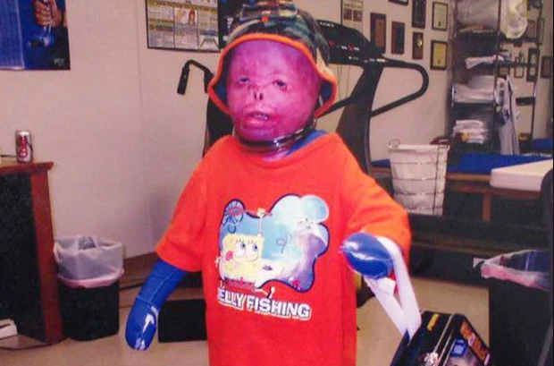 Chàng trai bỏng 95% cơ thể và nghị lực phi thường khiến cả thế giới khâm phục