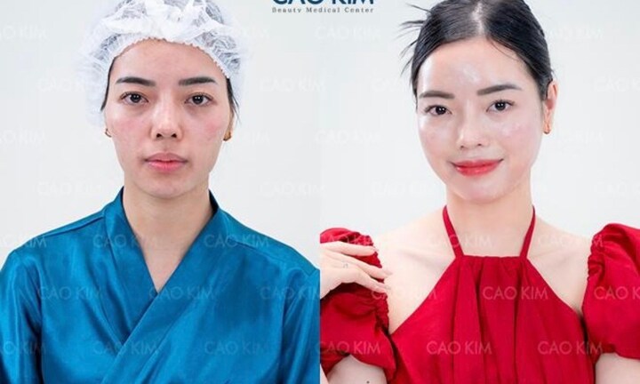 “So kè” các phương pháp làm đầy hốc hác trên gương mặt hot nhất hiện nay