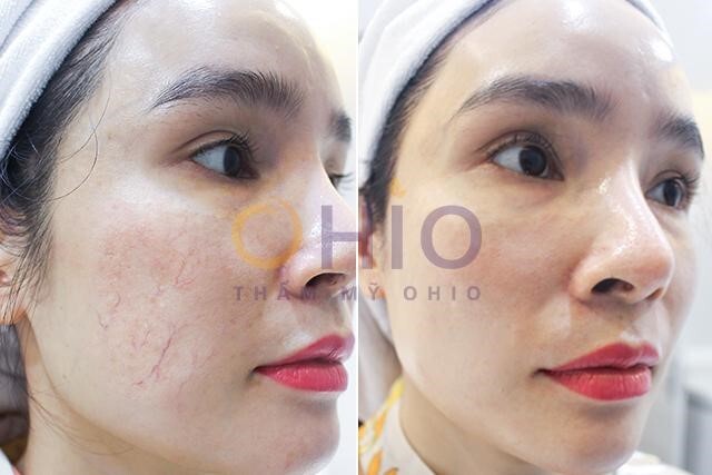 Tổng hợp trị giãn mao mạch ở các cấp độ nhìn hiệu quả muốn trị tức khắc