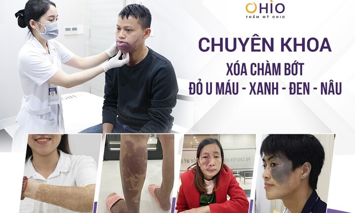 Hỗ trợ điều trị vết chàm bớt bẩm sinh uy tín tại Hà Nội